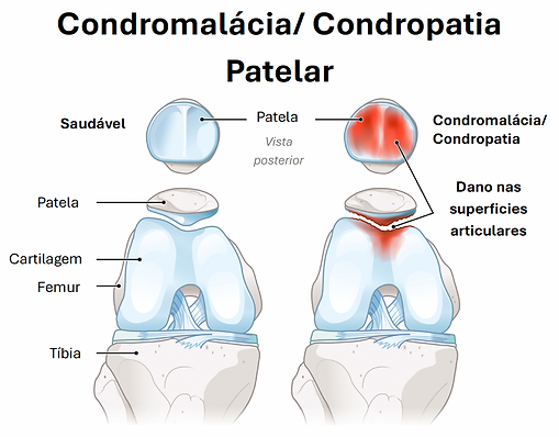 Condromalácia Patelar: Causas, Sintomas e Tratamentos | Dr. Amir Daher